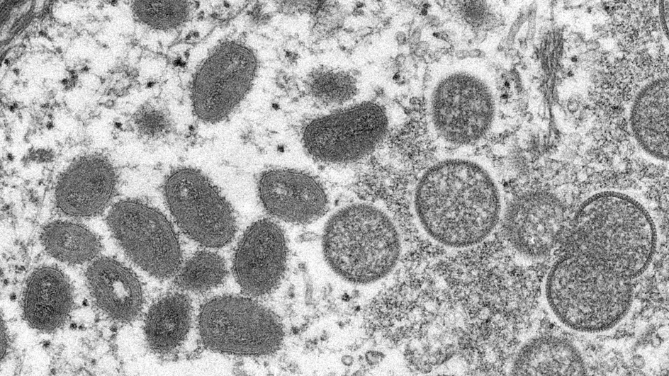     Deux cas suspects de variole du singe en Guyane

