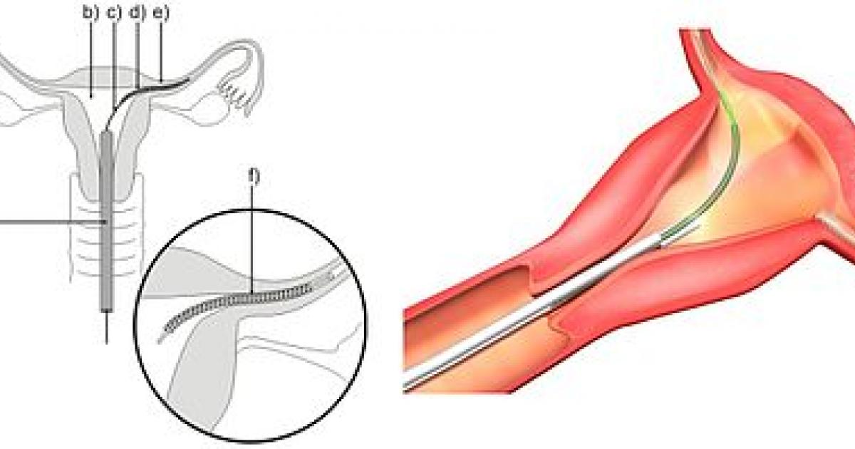     « Certaines femmes étaient en souffrance avec des implants Essure »

