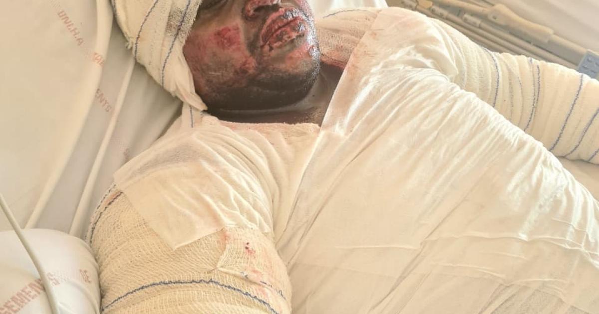     Jovany Six, rescapé d’un accident de travail, dénonce le silence d’Albioma et l’inaction des autorités

