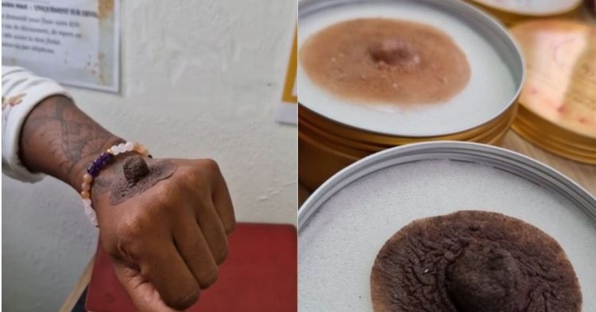     La prothèse de mamelon, un atout dans la reconstruction des femmes touchées par le cancer du sein

