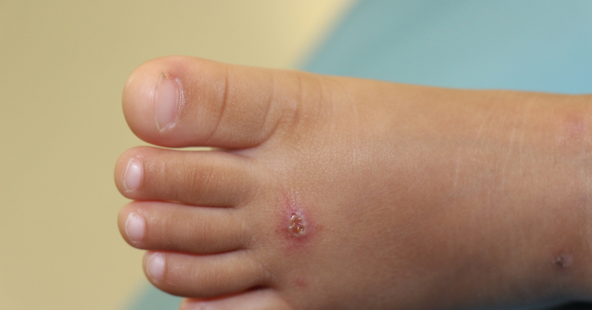     Face à la recrudescence de cas d'infections au staphylocoque doré, les autorités appellent à la prudence 

